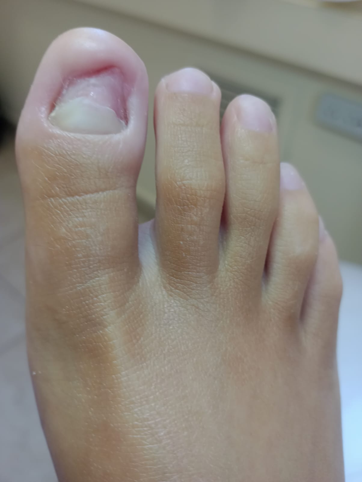 Después del tratamiento de Onicomicosis (hongo)